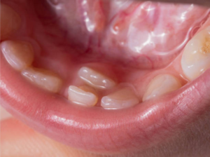 hyperdontia image 